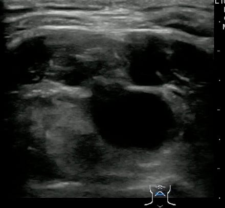 -Figure 34 - Thyroglossal Duct Cyst.jpg
