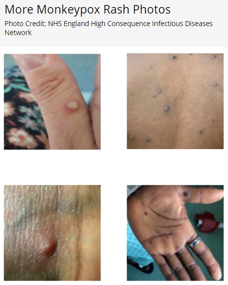 MonkeyPoxRashes2.jpg
