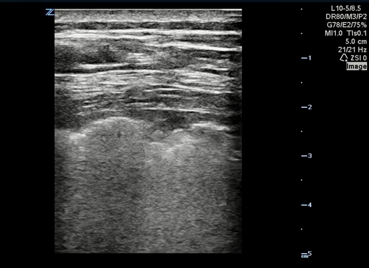 Lung Ultrasound.jpg