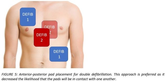 defibrillation