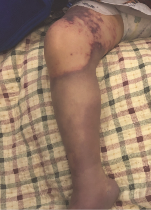 Figure 5: Right lower extremity, day 4 of admission. 