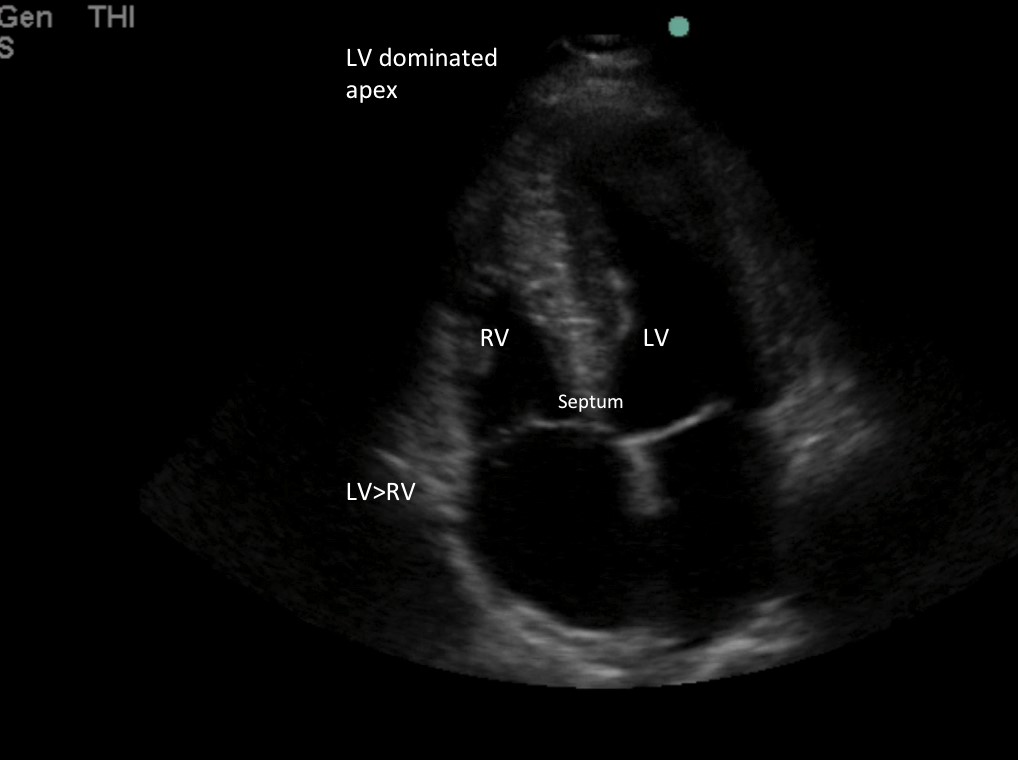 ACEP // Tips & Tricks: Right Heart Strain: rapid evaluation in the acutely dyspneic patient