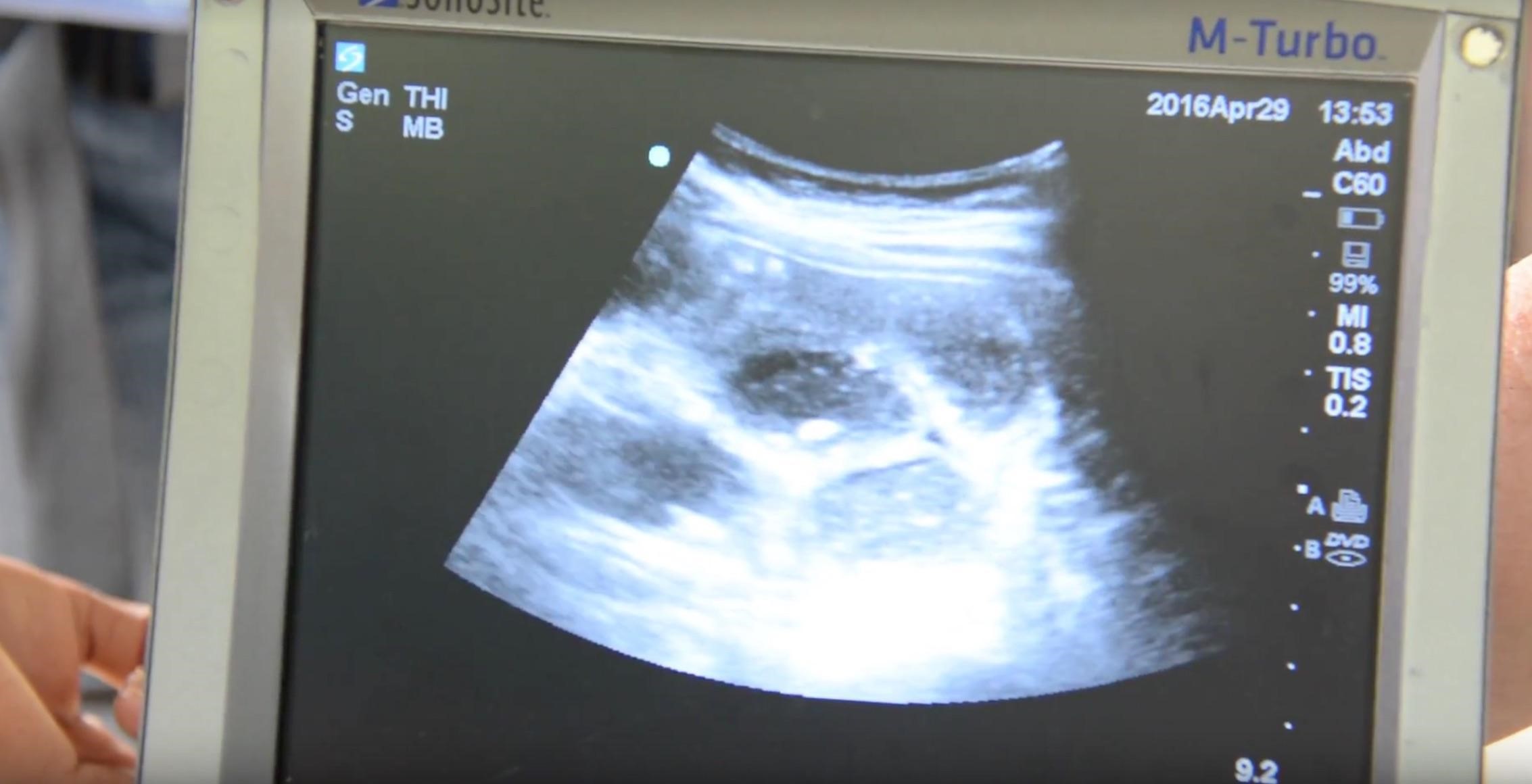 Intl Ultrasound Obstruction fig 1.jpg