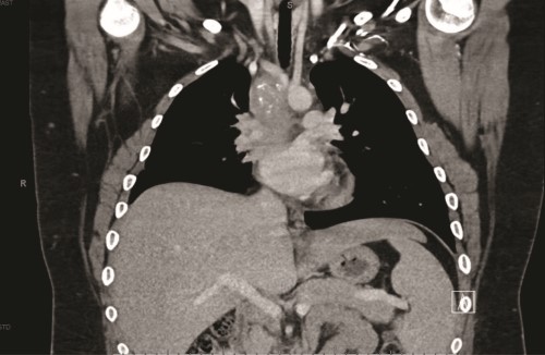 Figure 1.pdf.jpg Fibrosing Mediast