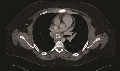 Figure 2.pdf.jpg Fibrosing mediasta