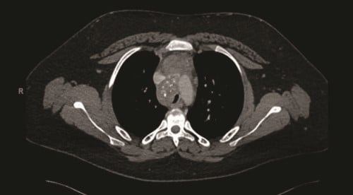 Figure 3.pdf.jpg Fibrosing mediast