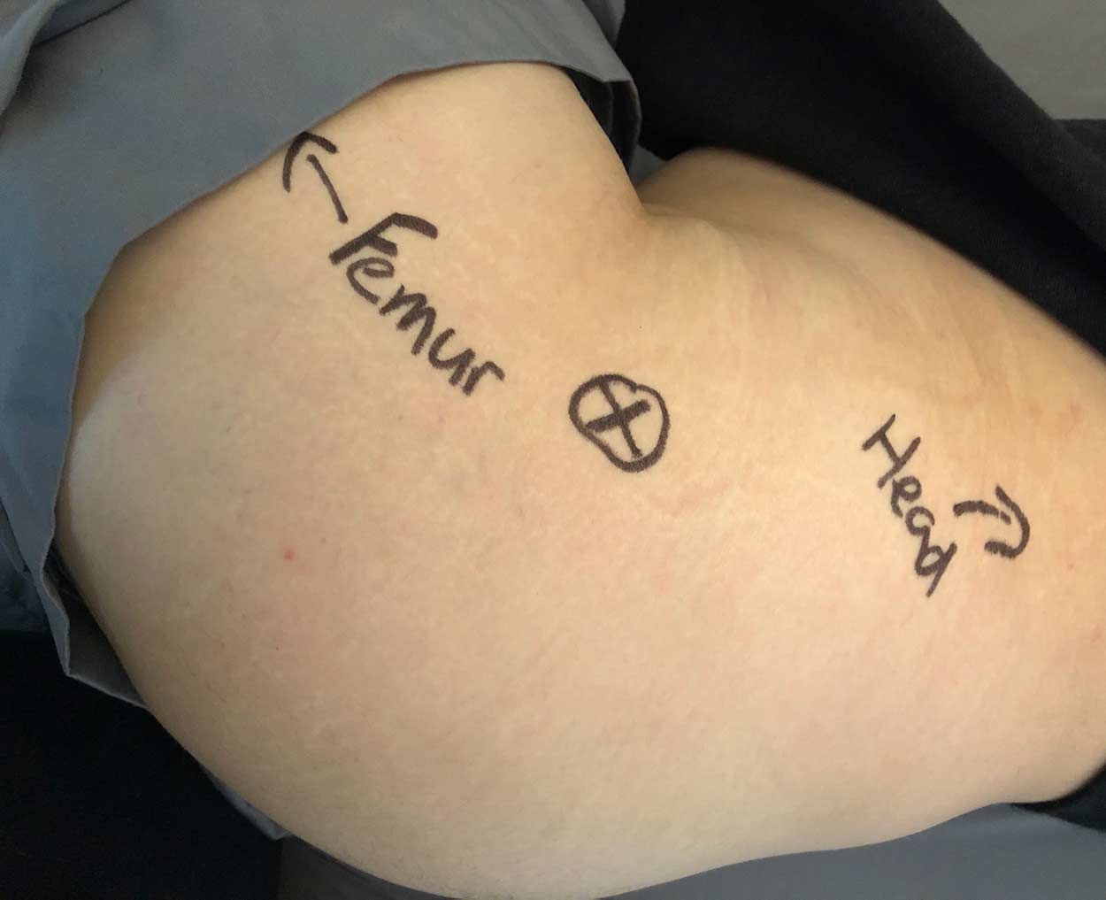 ACEP // Trochanteric Bursitis Injection