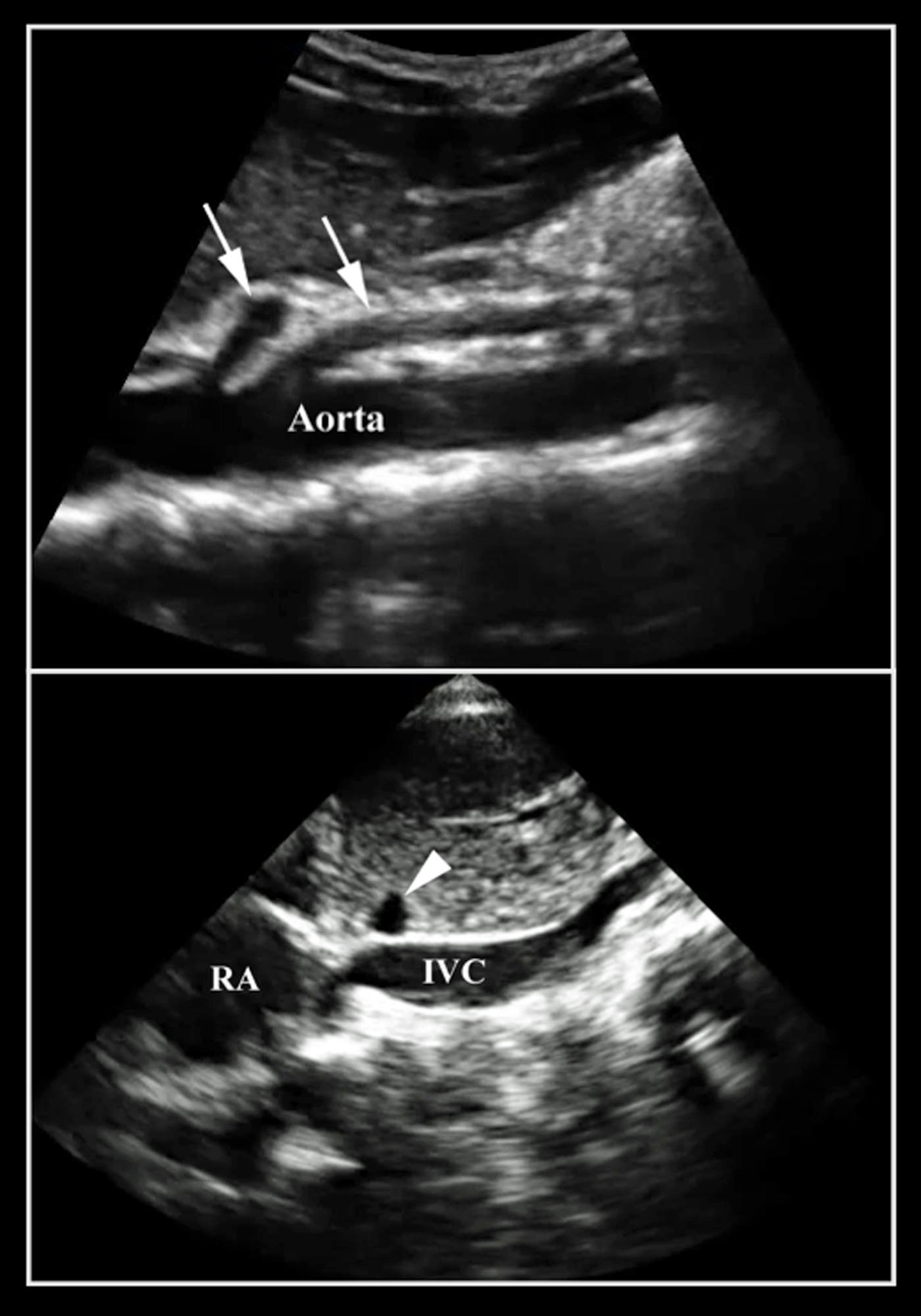Figure 10- Note the difference between the aorta and the IVC.jpg