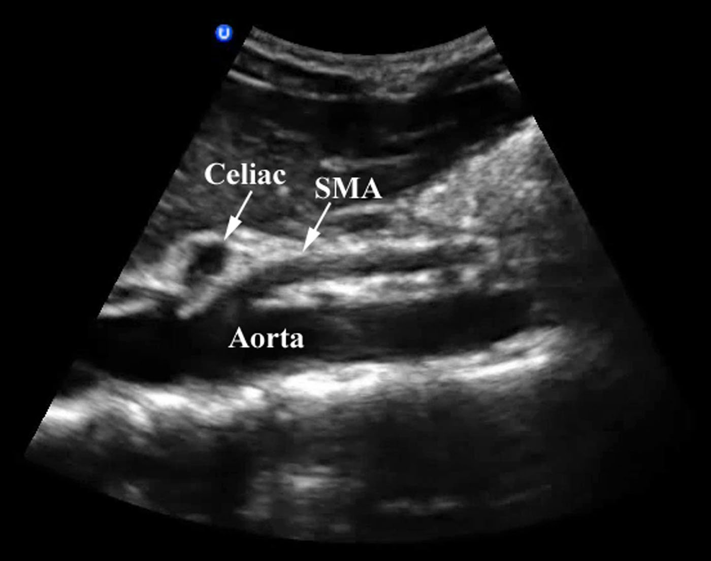 Figure 2- Aorta imaged in long axis with the celiac trunk and SMA branches.jpg