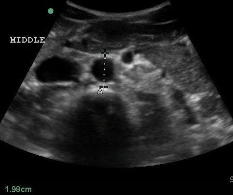 Figure 4 Transverse view of the mid aorta.jpg