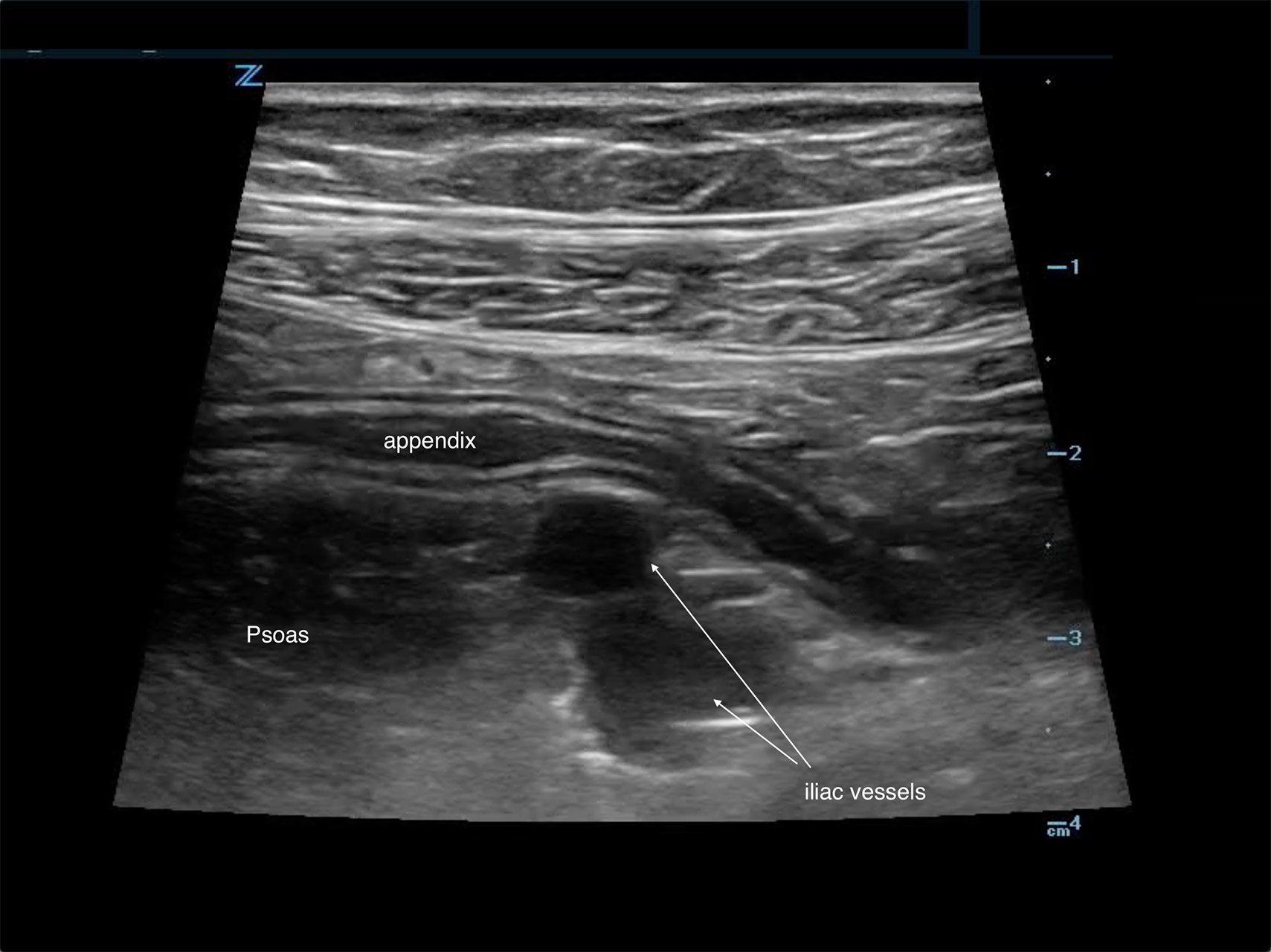 Appendicolith Ultrasound