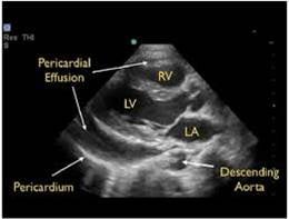 Image 15. Parasternal long axis showing pericardial effusion anterior to descending thoracic aorta.jpg