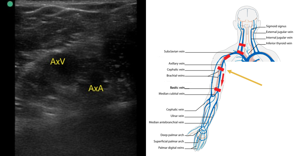 Figure 6 Axillary vein and artery.png