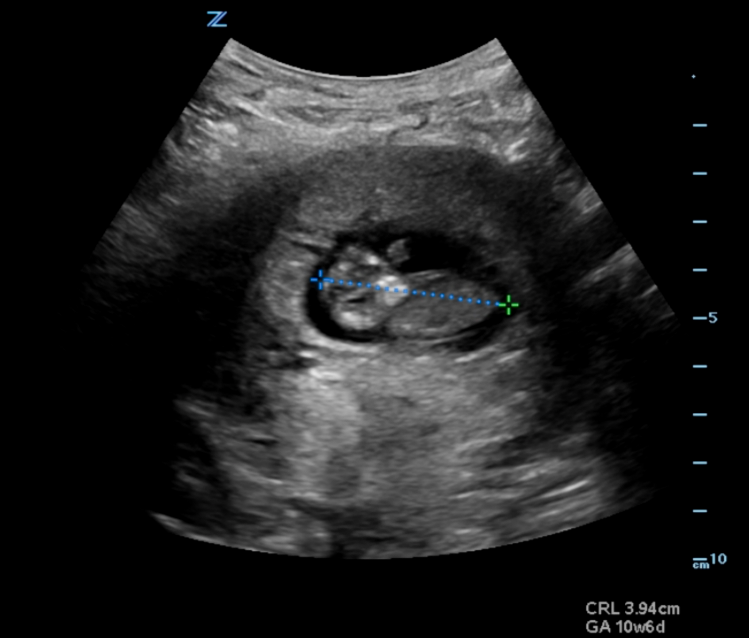 Sonoguide // Early Pregnancy