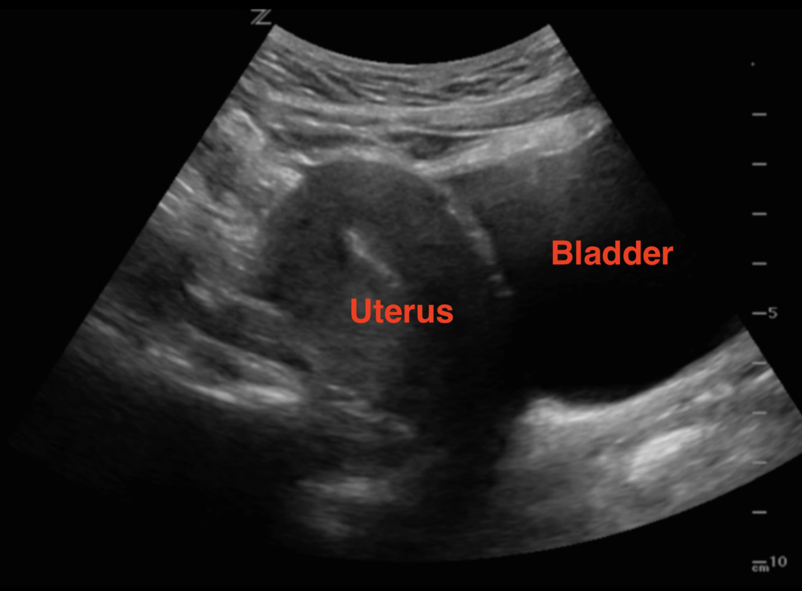 Uterus sac tilted ultrasound empty 6 weeks