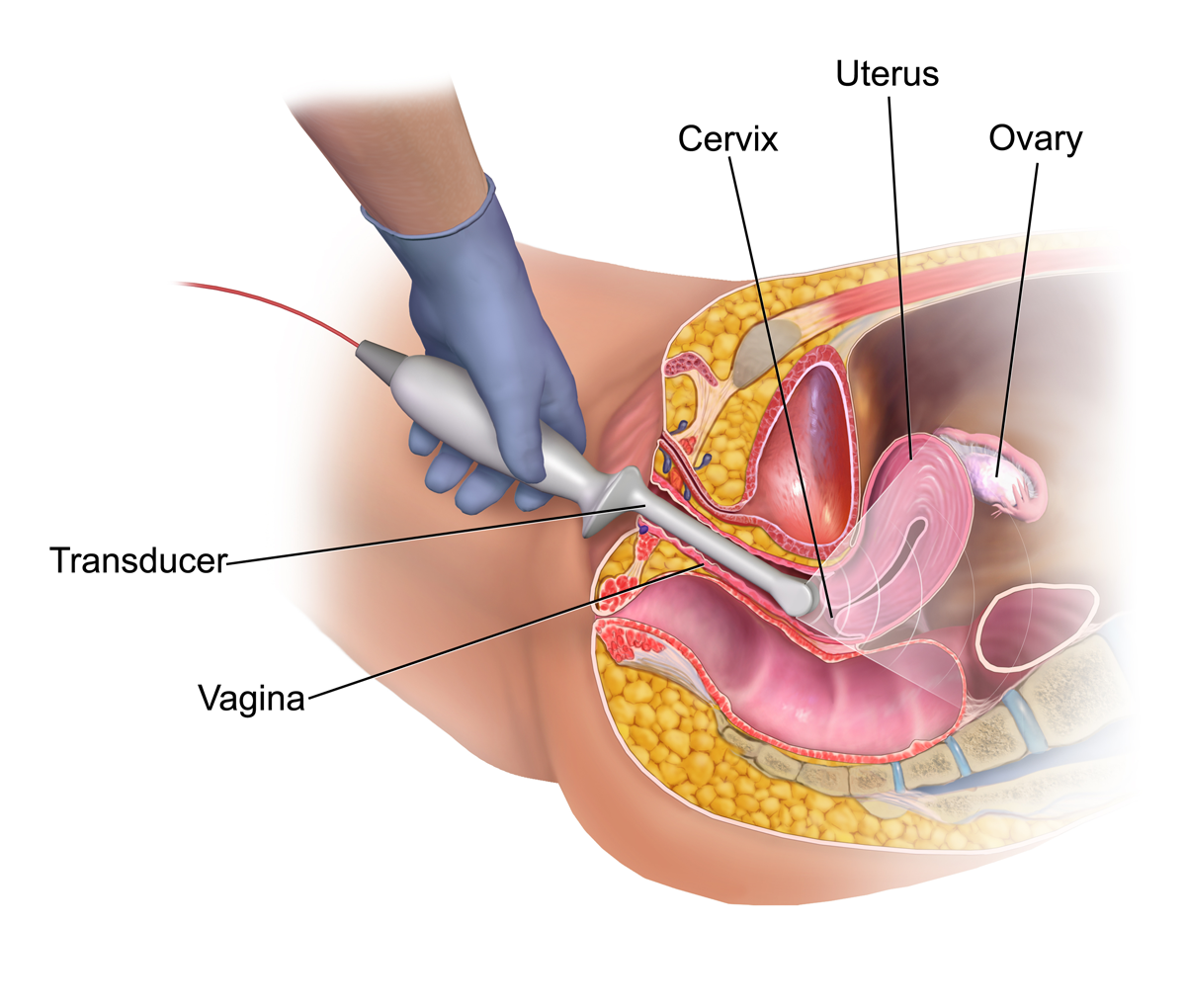 Illustration 7- Vaginal ultrasound (wikicommons).png