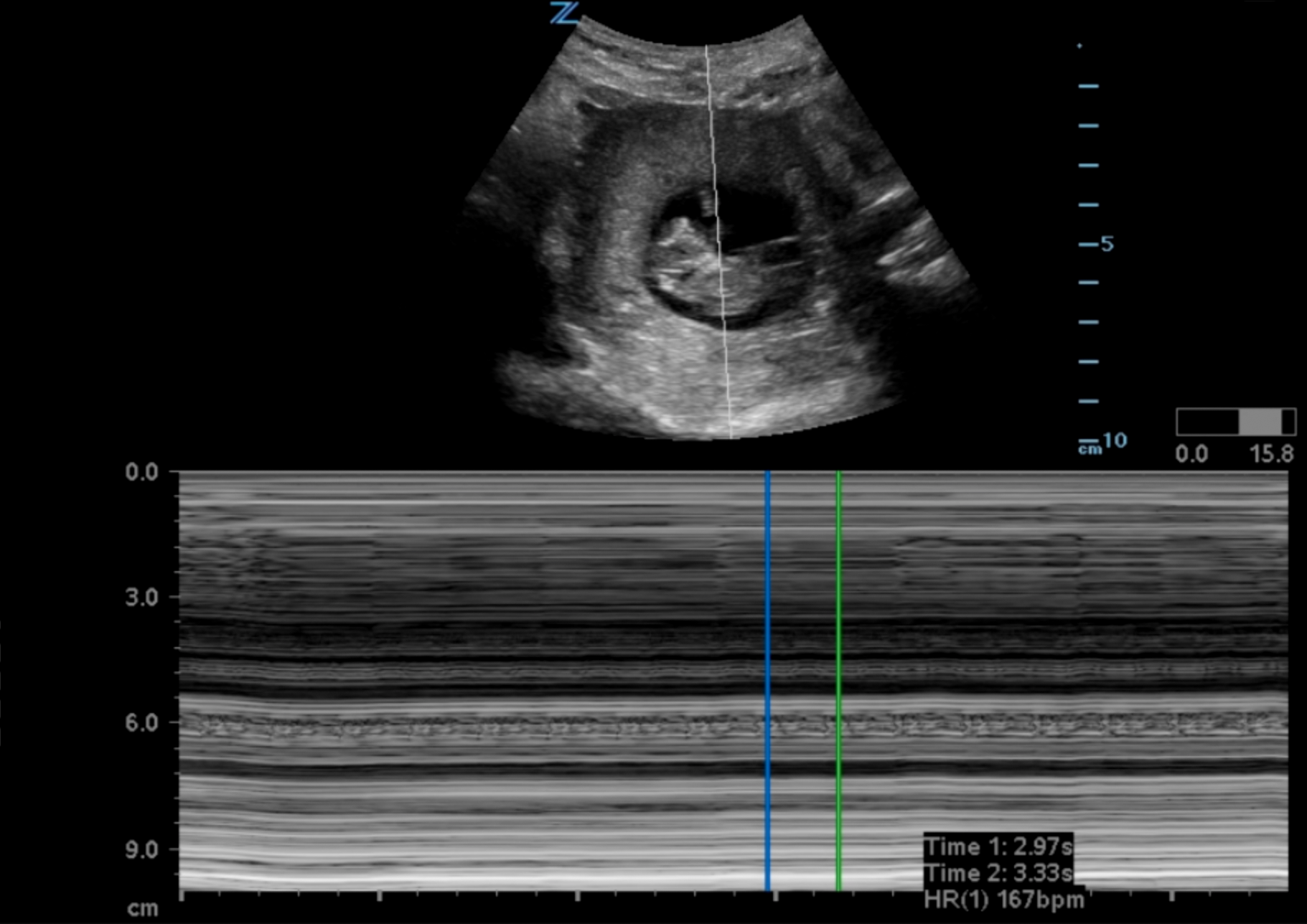 Illustration 9- M-mode for fetal heart rate.png