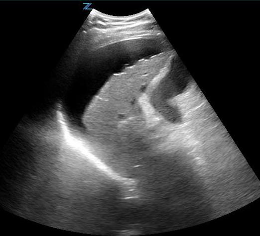 Figure 11 - Positive FAST scan with fluid in the abdomen superior to the liver .jpg