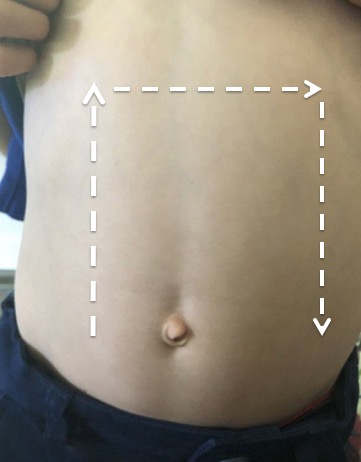 Figure 1- Surface anatomy image detailing abdominal point-of-care ultrasound for intussusception.jpg