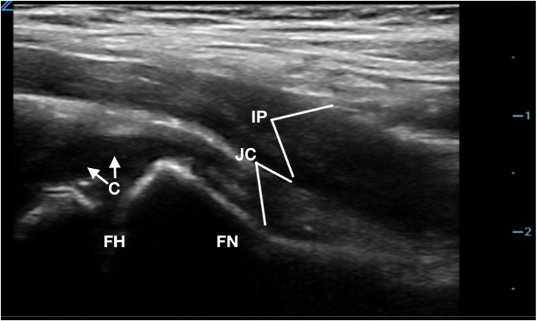 Figure 2. Anatomy of hip joint on ultrasound (C_ Cartilage_ physis on femoral head, FH_ Femoral Head, FN_ Femoral Neck, JC_ Joint Capsule, IP_ Iliopsoas muscle)_.png