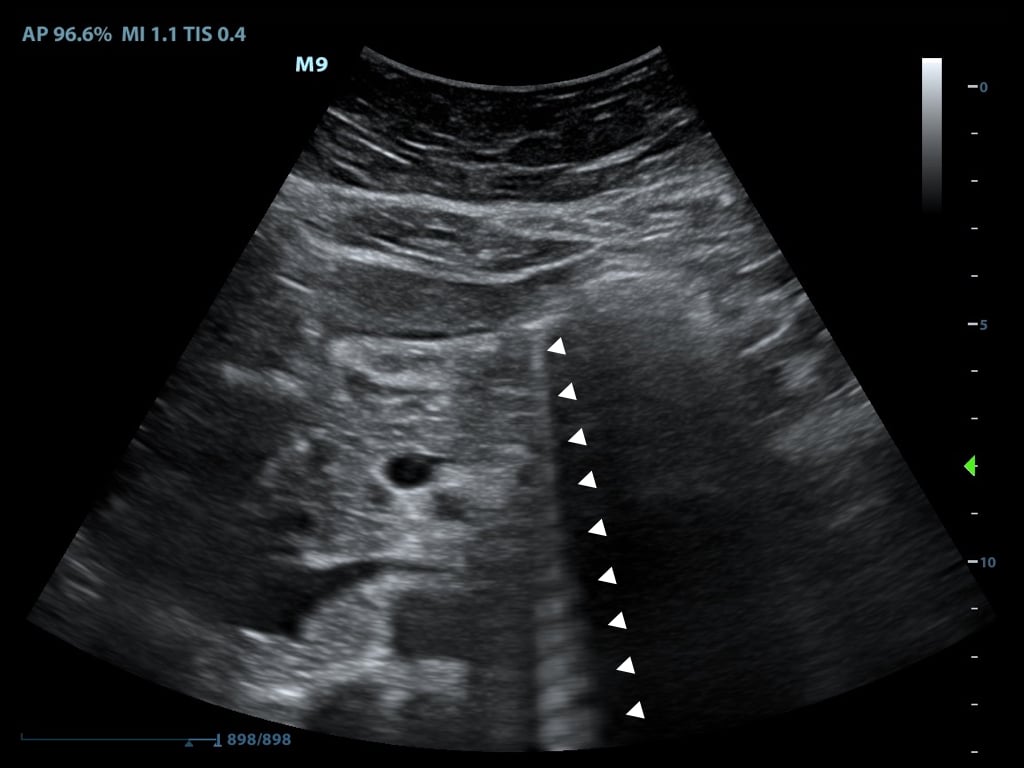 Figure11-Ring down artifact caused by bowel gas.jpeg