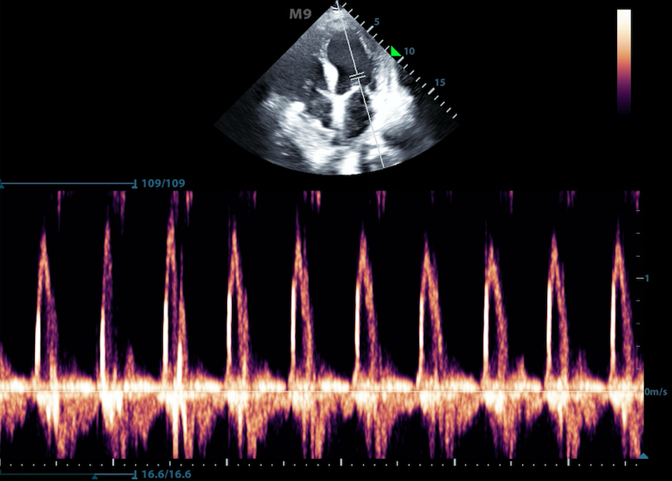 Figure5-Pulse wave doppler of flow through the mitral valve.png