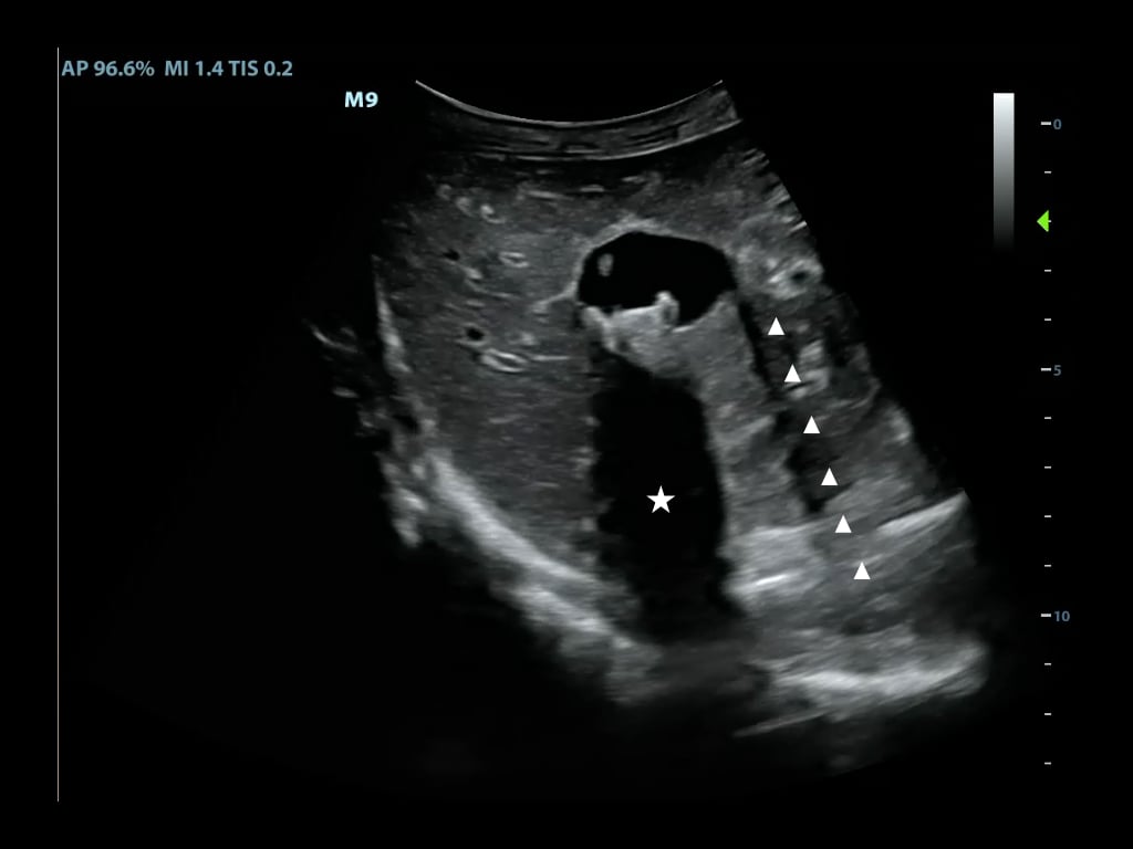 Figure7-Shadowing from gallstones and edge artifact at lateral wall of gallbladder.jpeg