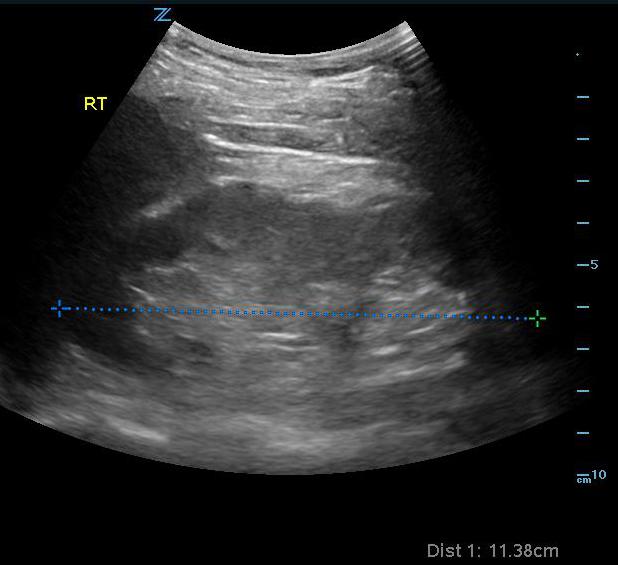 Sonoguide // Renal Ultrasound