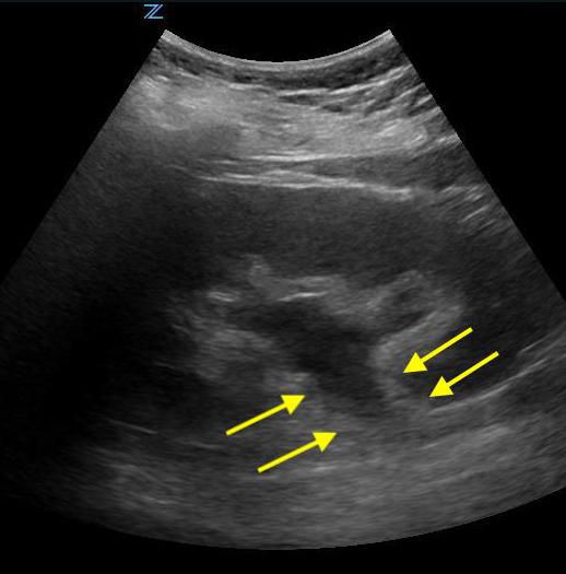 Figure 2-Moderate hydronephrosis demonstrating location of ureter (surrounded by arrows) exiting renal pelvis.jpg