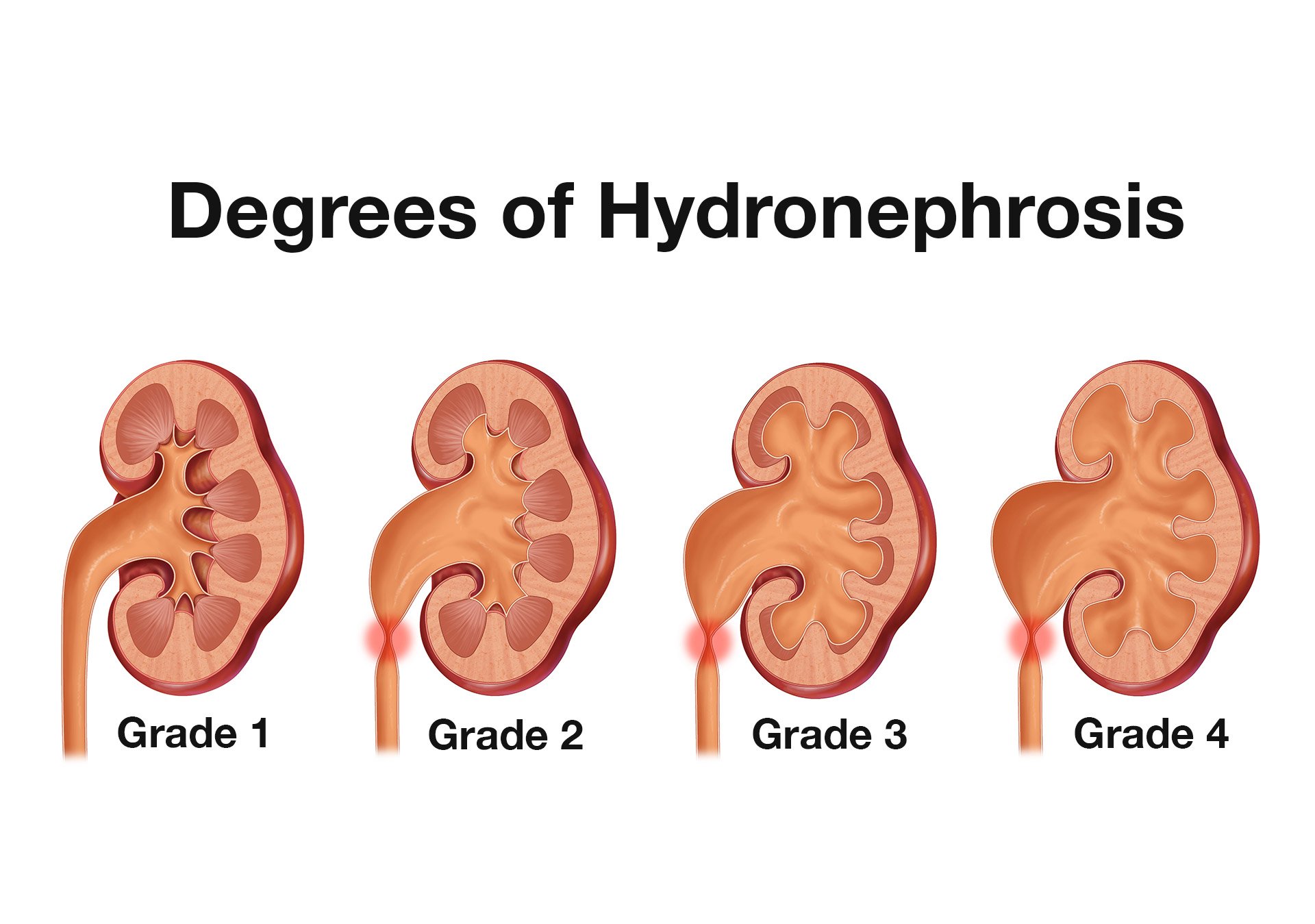 Illustration 2. Overview of degrees of hydronephrosis.jpg
