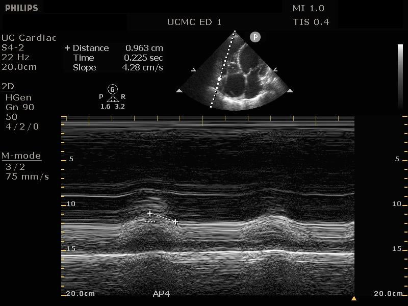 Sonoguide // Rapid Ultrasound for Shock and Hypotension (RUSH)