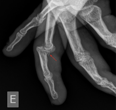 Sports Medicine Section // The Jammed Finger