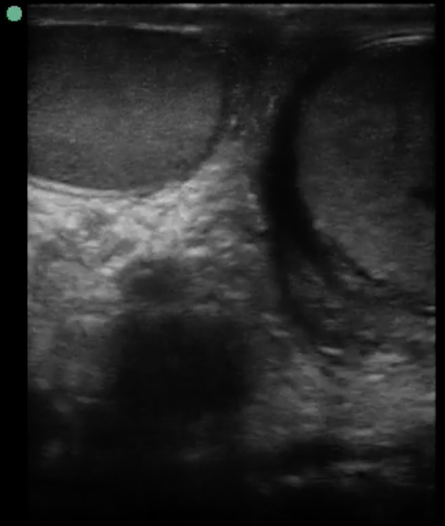 EM Ultrasound Section // Cases That Count Whirlpool Sign in Testicular
