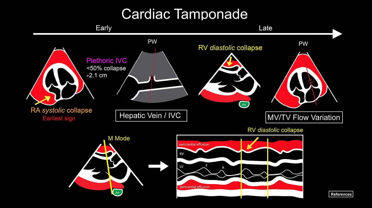 CardiacTamponade1425.jpg