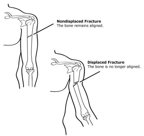 Open Fracture Arm Vignette Pic