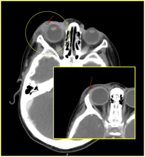 CT Scan Periorbital Erythema and Edema