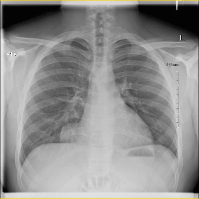 Sports Medicine Section // Case Report Intrathoracic Liver Herniation