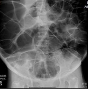 AbdominalDistention-1.jpg