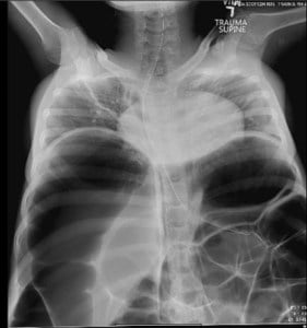 AbdominalDistention-3.jpg