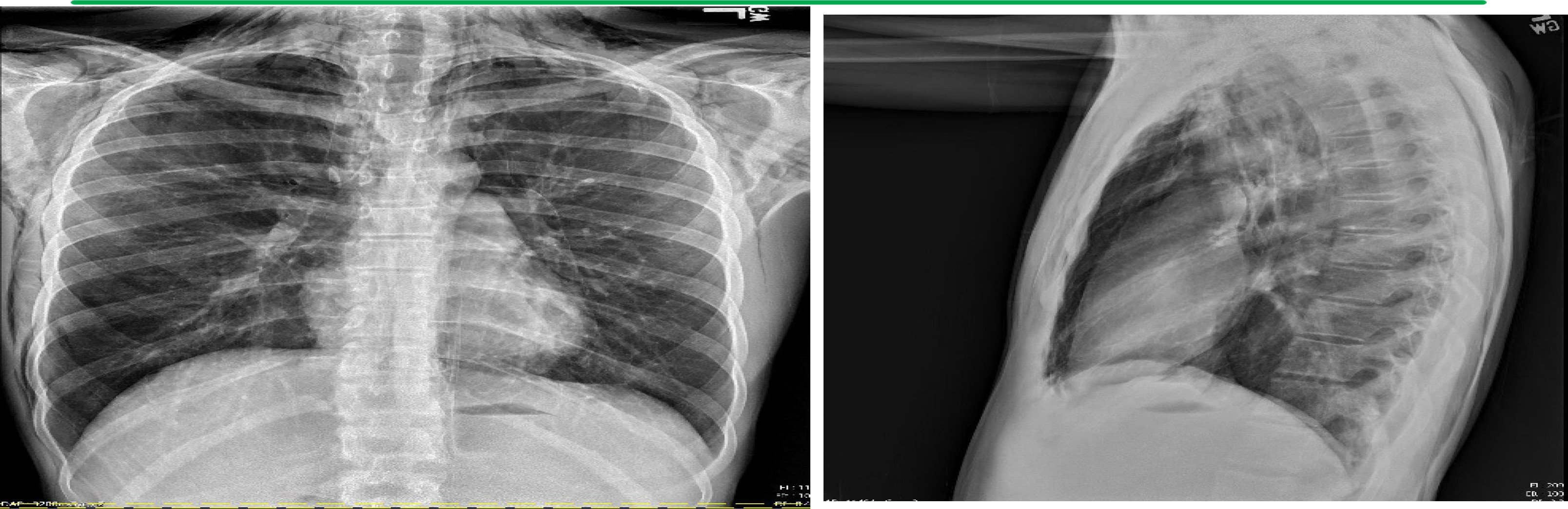 Abramo Pneumomediastinum x-ray 2.jpg