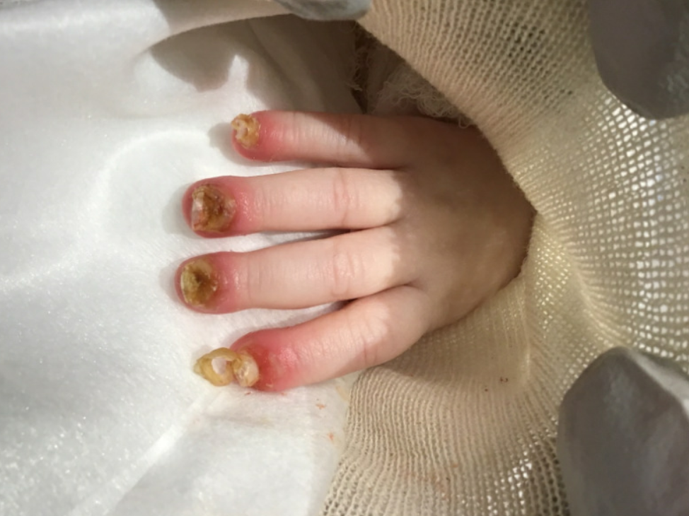 junctional epidermolysis bullosa nails 2.jpg