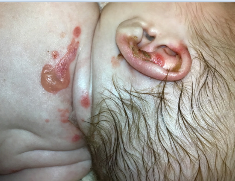 junctional epidermolysis bullosa rash 3.jpg