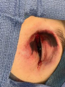 SwollenEye-1.jpg