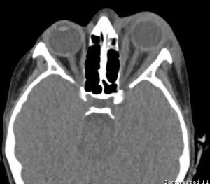 SwollenEye-2.jpg