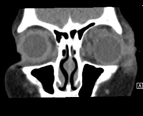 SwollenEye-3.jpg