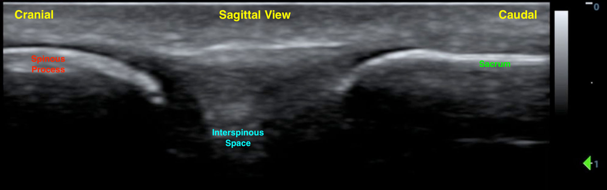 LB Figure 3. Sagittal spinous process and sacrum.jpg