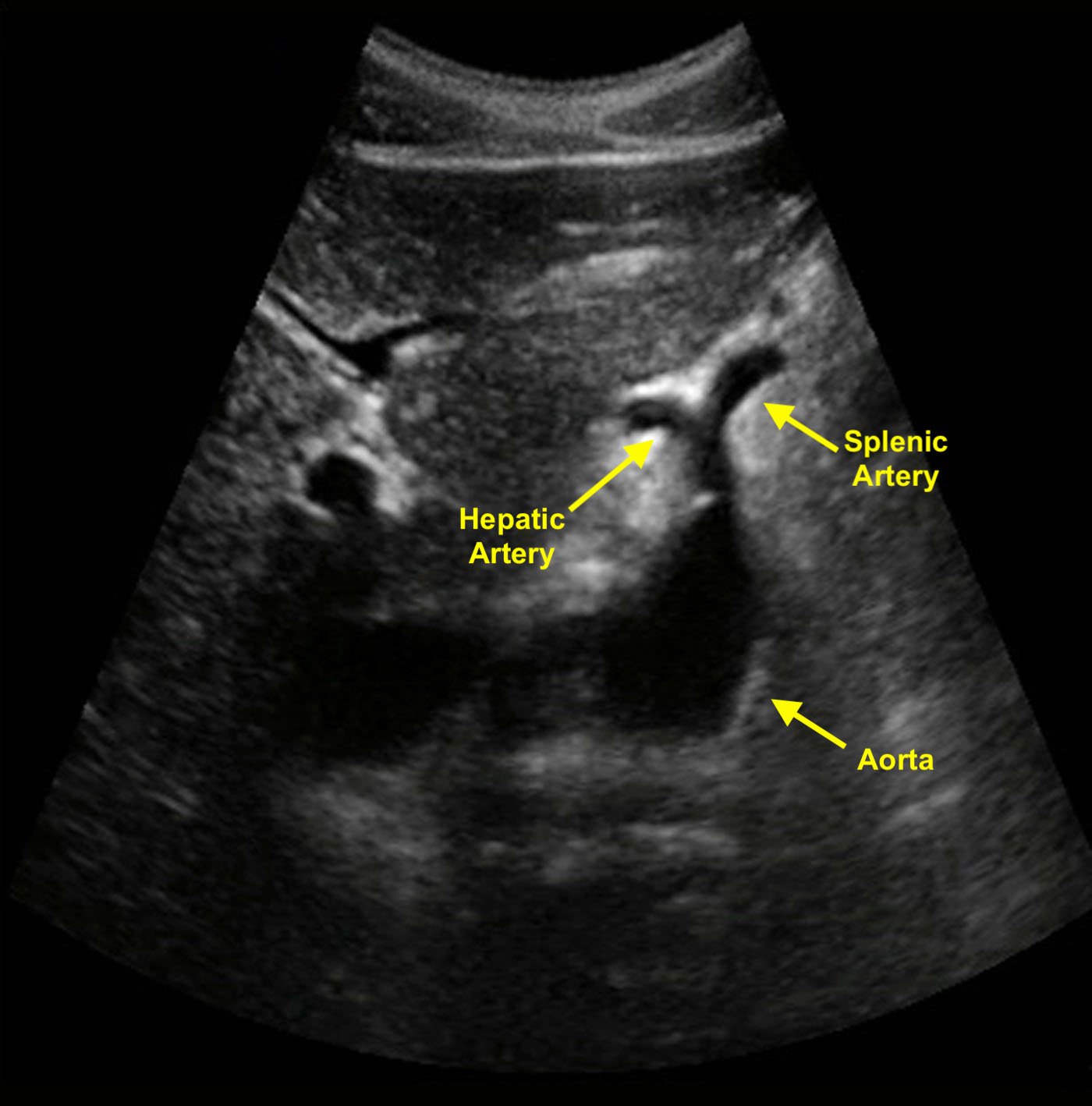 Figure 1 - Transverse image of the aorta shows a classic example of the seagull sign. The celiac trunk branches into the hepatic and splenic arteries..jpeg