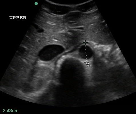 Figure 3- Transverse view of the proximal aorta.jpg