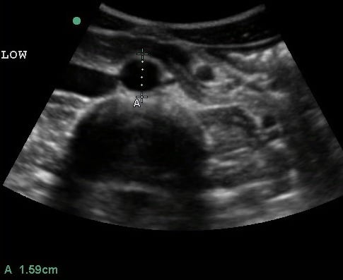 Figure 5 Transverse view of the distal aorta.jpg