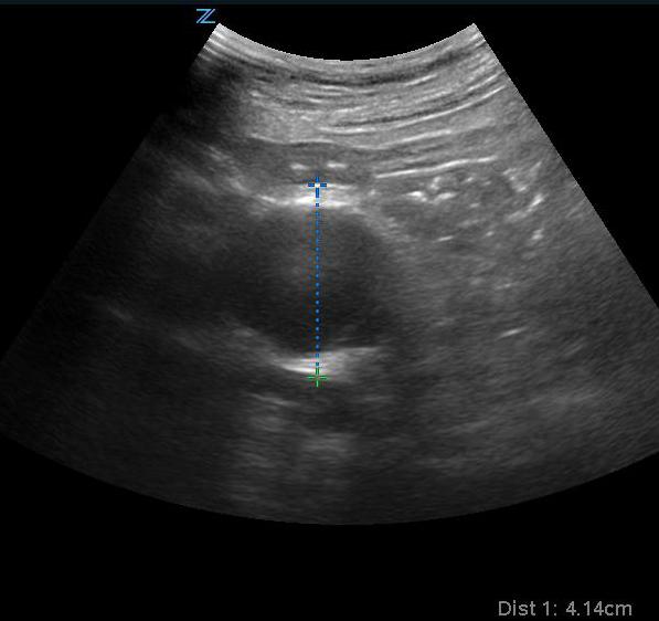 Figure 7- Transverse view of a 4.1 cm AAA.jpg